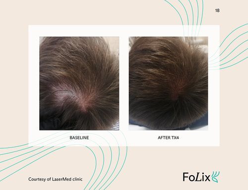 Folix Hair Restoration - J.Bentley Hair Studio Day Spa | Powell, OH